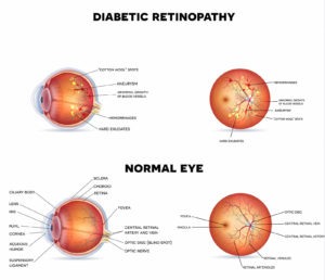 What Is Diabetic Retinopathy And What Causes It?