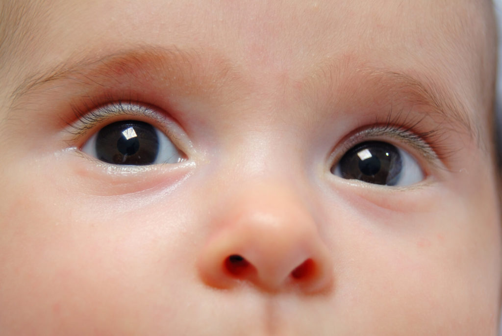 Congenital Cataracts: Yes, Babies Can Have Cataracts Too