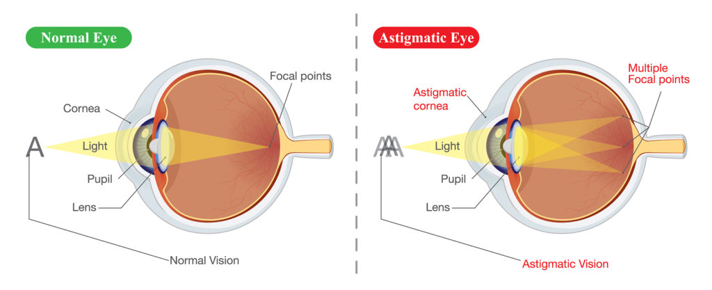 Keeping Astigmatism at Bay: The Best Fixes