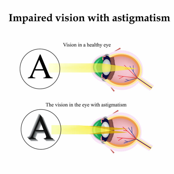 How to Naturally Improve Poor Vision Caused by Astigmatism