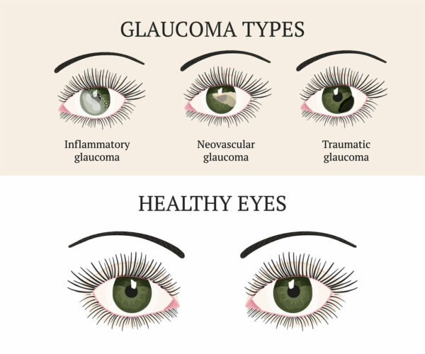 natural-ways-to-lower-eye-pressure