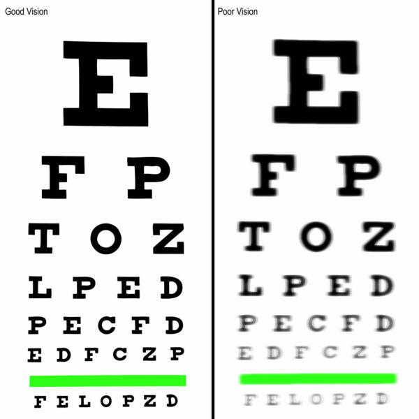 Eye Exercises for People with Different Prescriptions for Each Eye