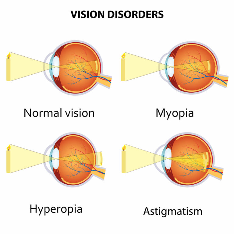 myopia-hyperopia-and-astigmatism-explained