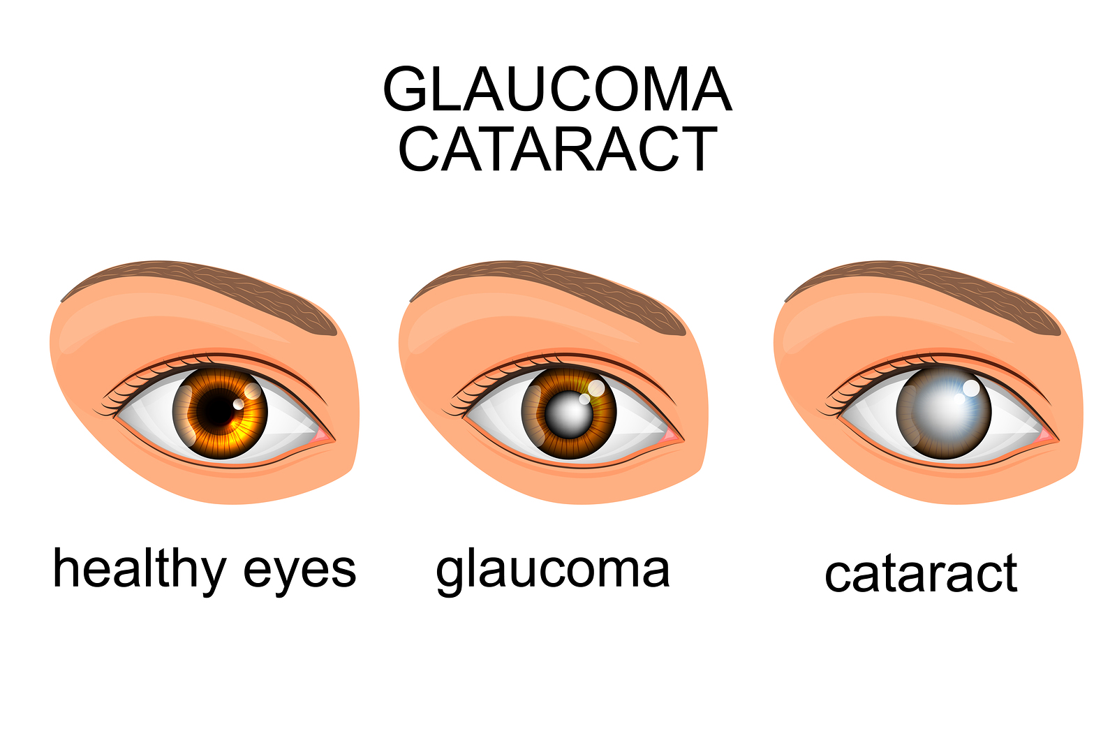 Common Eye Disorder Glossary